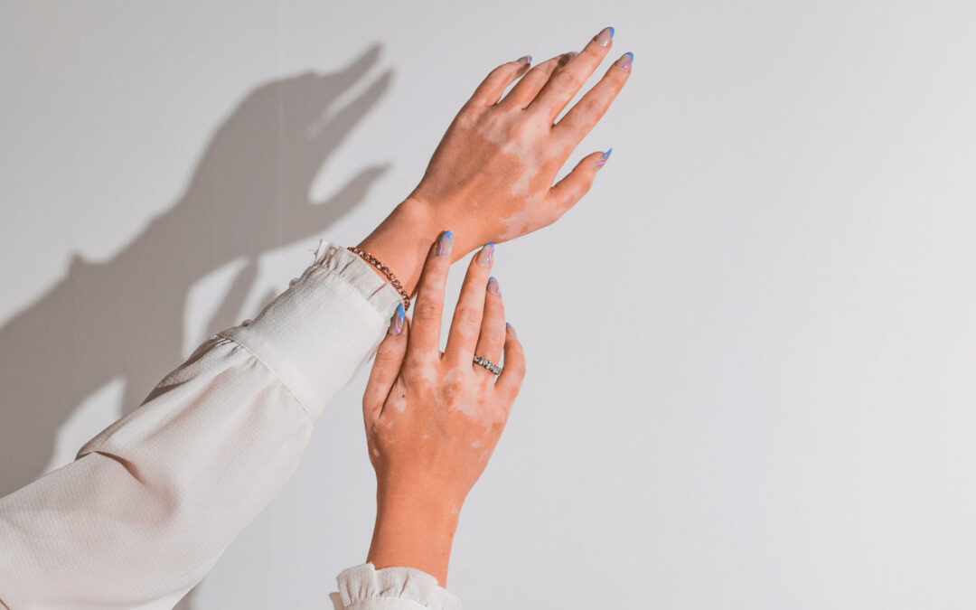 Crema dermoprotettiva per dermatiti, couperose e altre condizioni cutanee il rimedio naturale con latte d’asina