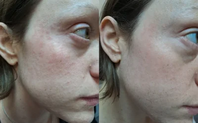 Crema dermoprotettiva: il rimedio naturale per rosacea, irritazioni e pelle sensibile