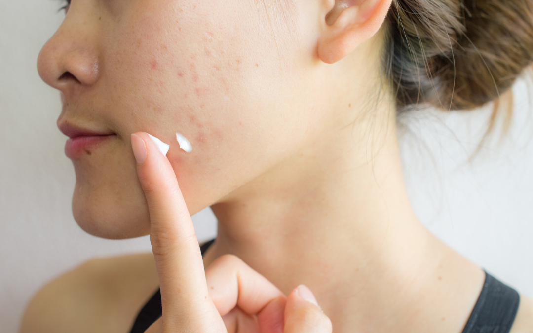Acne: come curarla con la crema dermoprotettiva naturale